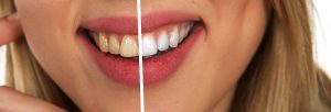 חיוך של מיליון דולר מתחת לחופה: איך להפוך שיניים פגועות לחיוך לבן ויפה